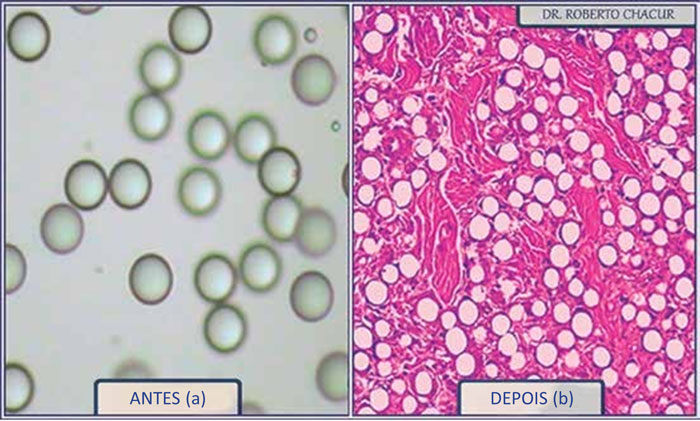 microesferas de pmma antes de serem injetadas dispersas em carboximetilcelulose e depois dentro do músculo envoltas por fibras de colágeno