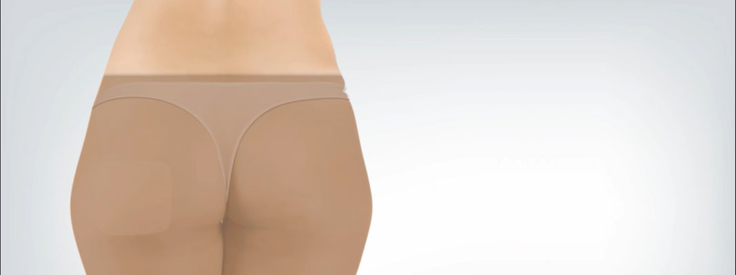 ilustração digital de gluteo com curativo e bermuda compressiva após goldincision