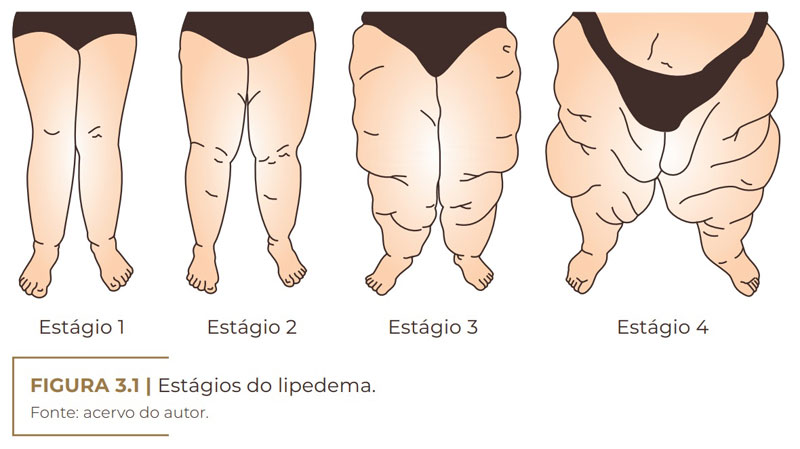 Lipedema: Entenda a diferença entre tumor de gordura e deposição anormal de  gordura nas pernas e glúteos.