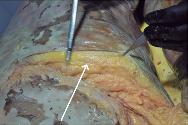 anatomia fascia superficial no tratamento da celulite