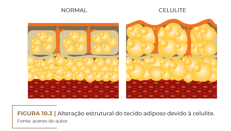 Alteração estrutural do tecido adiposo devido à celulite.