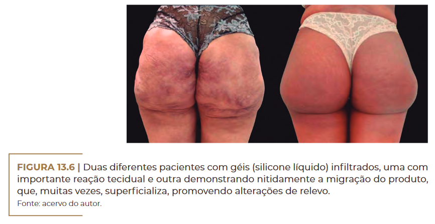 Duas diferentes pacientes com géis (silicone líquido) infiltrados