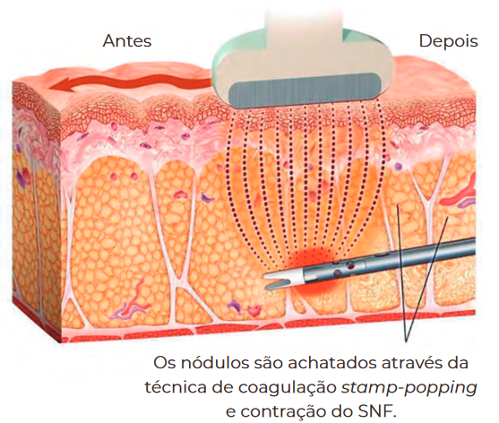 Mecanismo CelluTite em ação – nódulos achatados