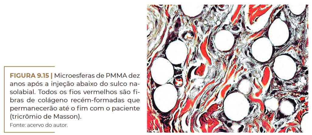 Microesferas de PMMA dez anos.