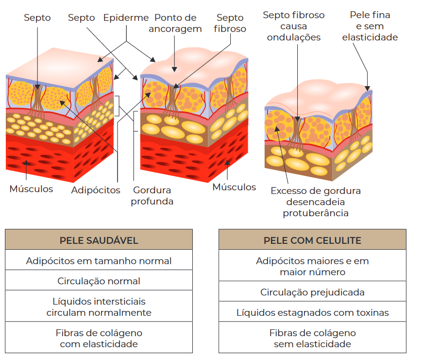 INFLUÊNCIA DOS HORMÔNIOS NA CELULITE: COM ÊNFASE NA ADIPONECTINA