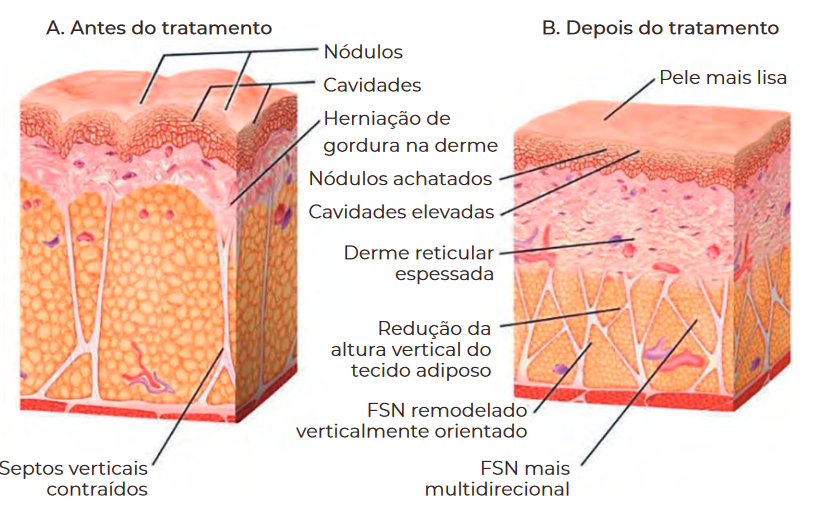 Remodelação após tratamento CelluTite