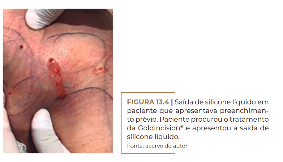 Saída de silicone líquido