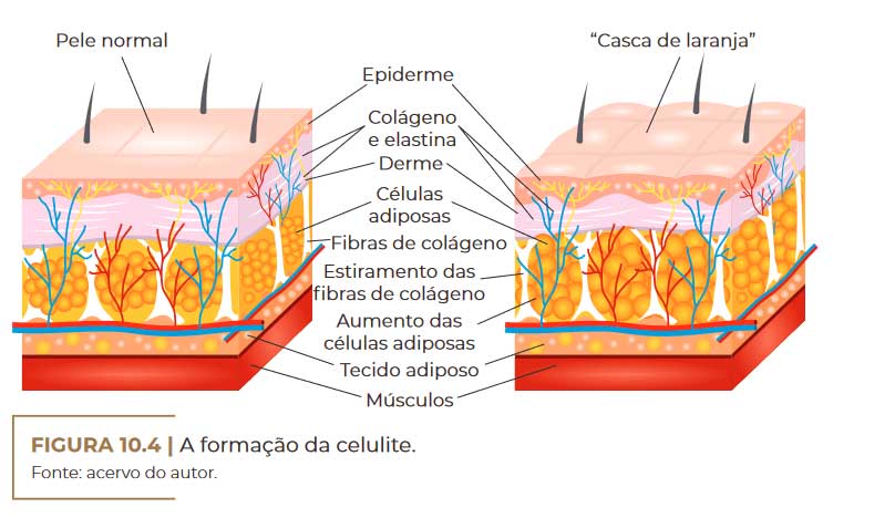 a-formacao-da-celulite