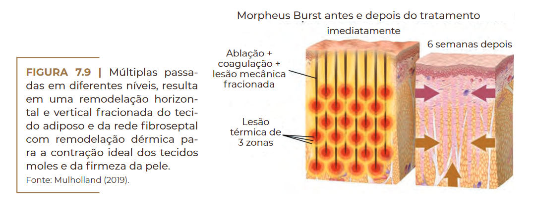 Morpheus Burst antes e depois do tratamento