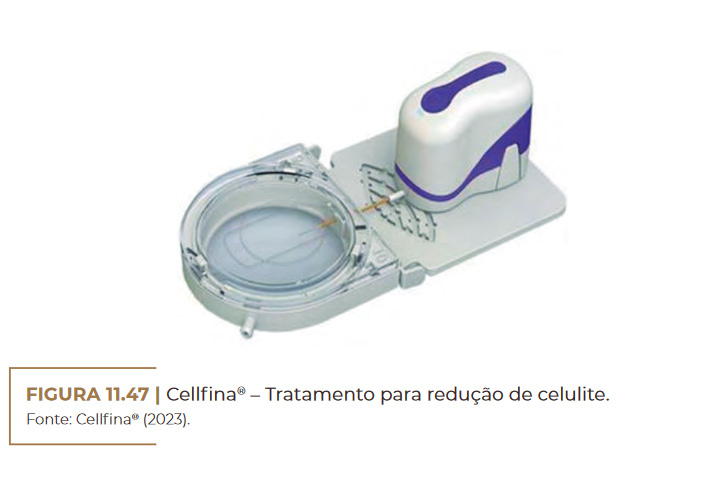 cellfina–descolamento-celulite