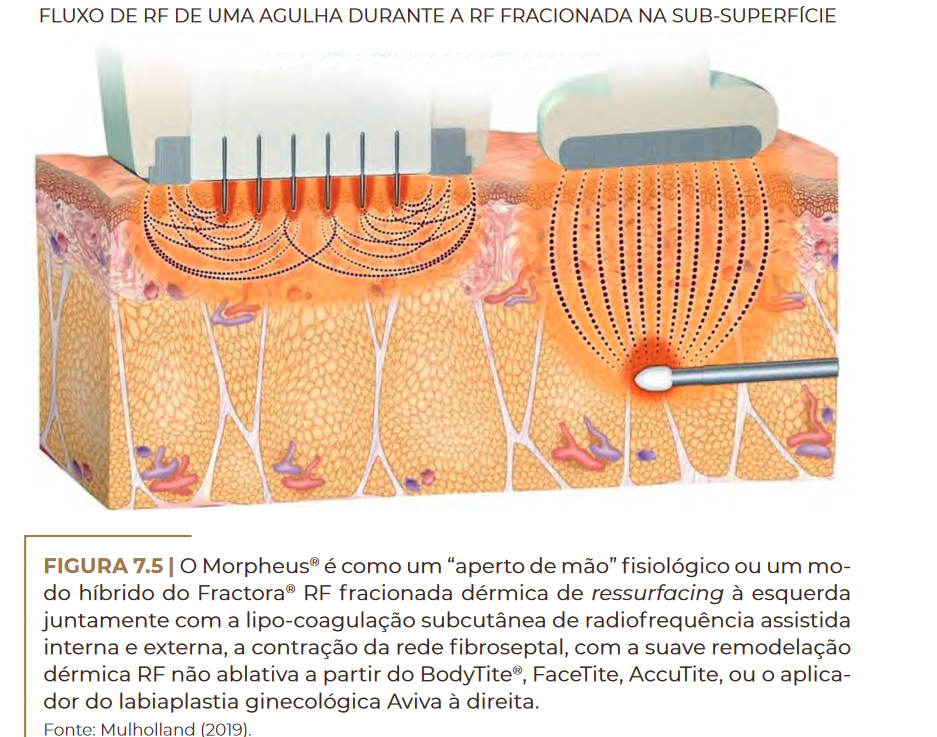 FLUXO DE RF DE UMA AGULHA DURANTE A RF FRACIONADA NA SUB-SUPERFÍCIE