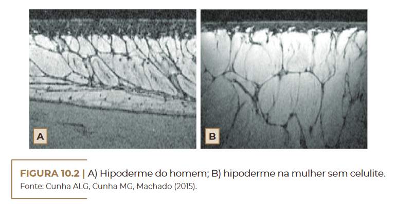 A) Hipoderme do homem; B) hipoderme na mulher sem celulite