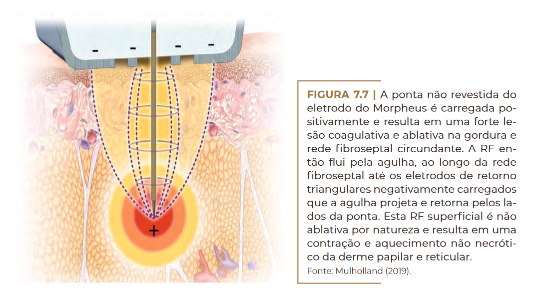 A ponta não revestida do eletrodo do Morpheus é carregada po- sitivamente e resulta em uma forte le- são coagulativa e ablativa na gordura e rede fibroseptal circundante.