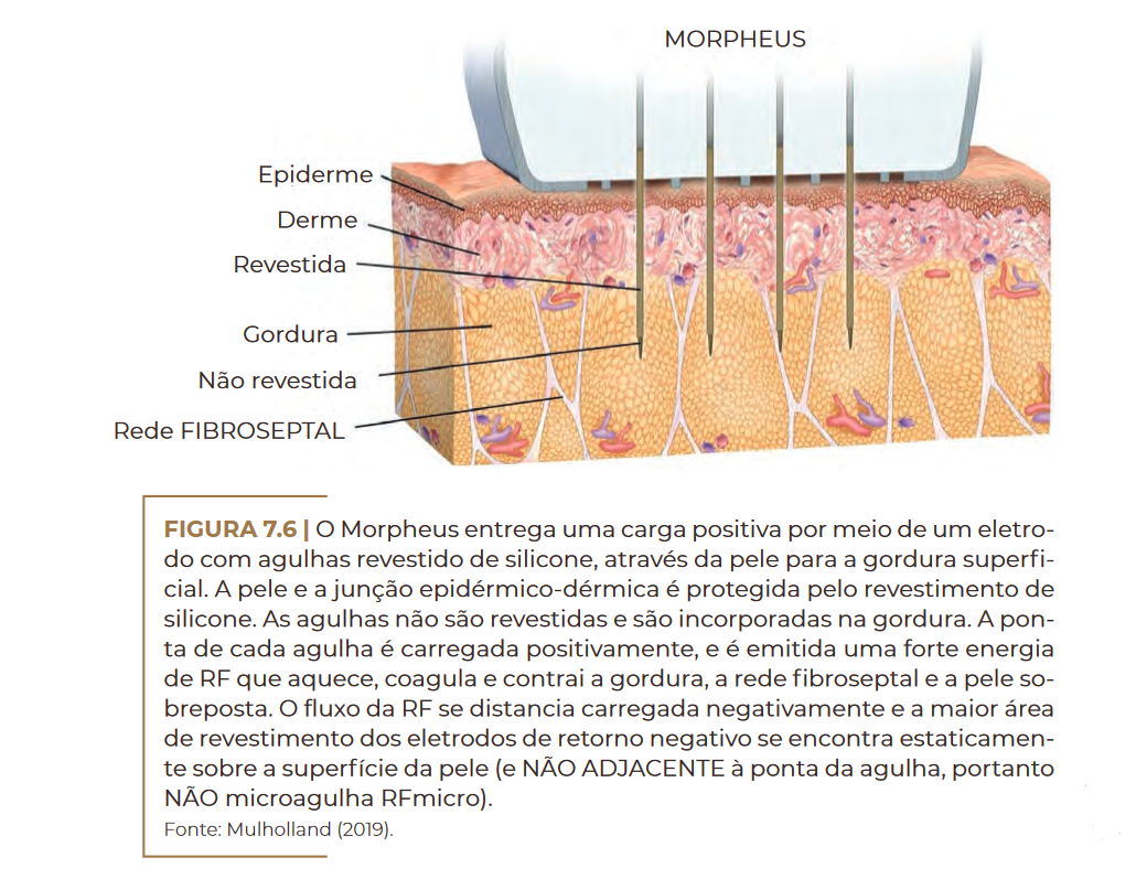 O Morpheus entrega uma carga positiva por meio de um eletro- do com agulhas revestido de silicone, através da pele para a gordura superfi- cial.