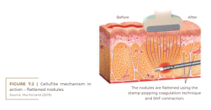 CelluTite mechanism in action – flattened nodules.