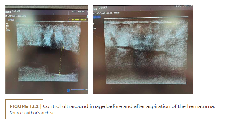 Control ultrasound image before and after aspiration of the hematoma