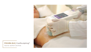 CoolSculpting®