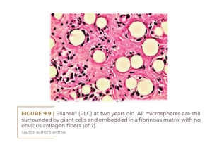 Ellansé® (PLC) at two years old.