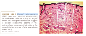 Ellansé® microspheres (PLC)