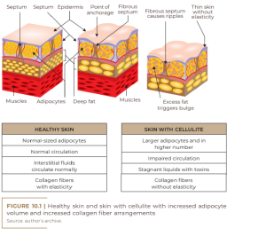 Healthy skin and skin with cellulite