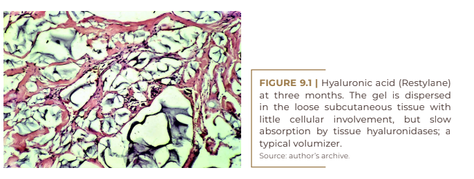 Los Deline  Injectable Volumizing Implant - BREAST PTOSIS (SAGGING):  CAUSES AND CLASSIFICATION