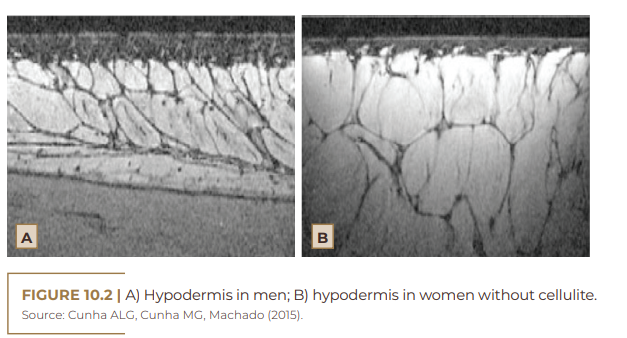 A) Hypodermis in men; B) hypodermis in women without cellulite