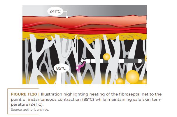  Illustration highlighting heating of the fibroseptal