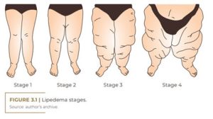 Lipedema stages, 1 to 4