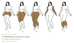 lipedema types, 1 to 4