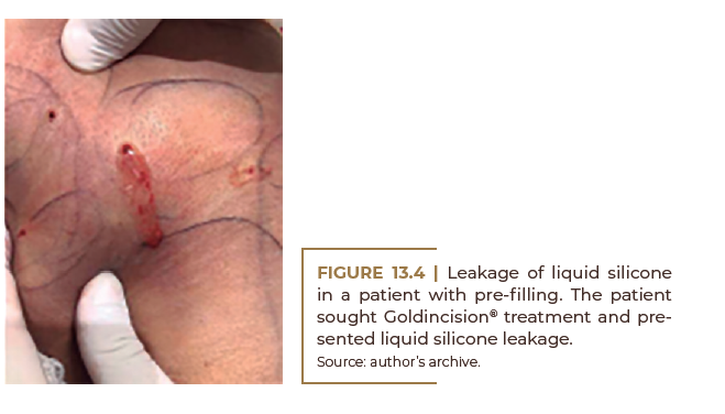 Leakage of liquid silicone in a patient with pre-filling