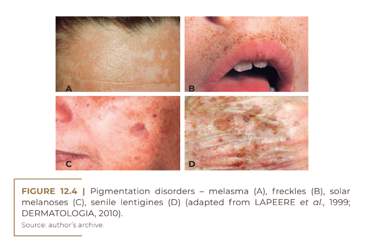 Pigmentation disorders