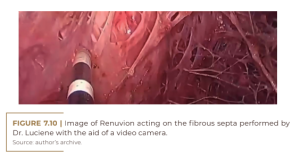 Image of Renuvion acting on the fibrous septa performed by Dr. Luciene with the aid of a video camera.