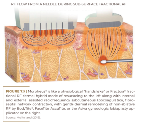 RF FLOW FROM A NEEDLE DURING SUB-SURFACE FRACTIONAL RF