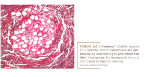 Radiesse® (CaHA) nodule  at 3 months.