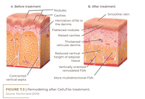 Remodeling after CelluTite treatment.