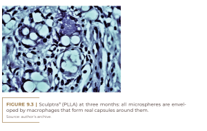 Sculptra® (PLLA) at three months: