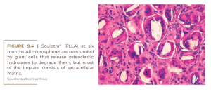 Sculptra® (PLLA) at six  months.