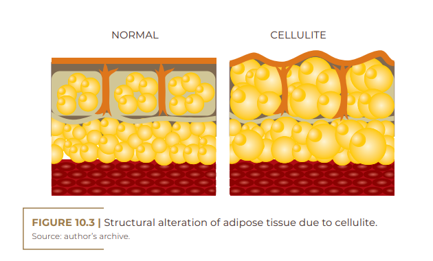 Structural alteration of adipose tissue due to cellulite