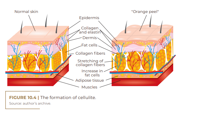 The formation of cellulite