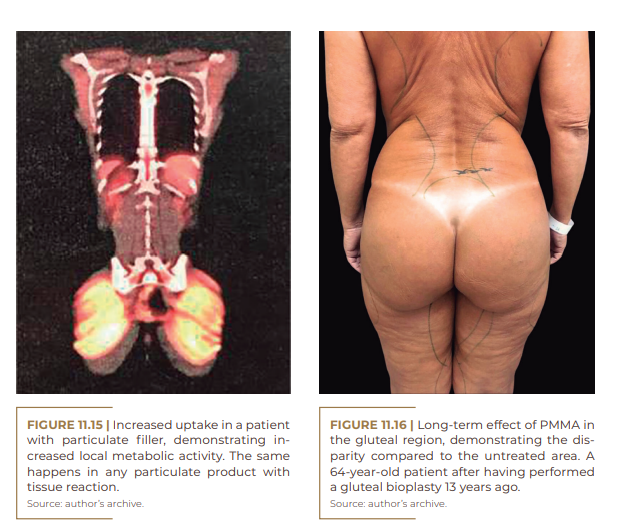 | Increased uptake in a patient with particulate filler, demonstrating increased local metabolic activity. 