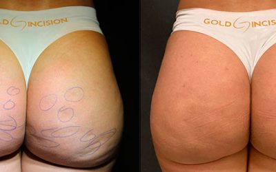 Tratamento para celulite nas coxas e glúteos com protocolo GoldIncision dois meses depois