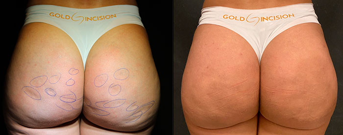antes e depois de Tratamento para celulite nas coxas e glúteos com GoldIncision dois meses depois