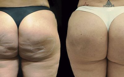 Tratamento de lipodistrofia glútea com retração extensa utilizando tratamento avançado para celulite