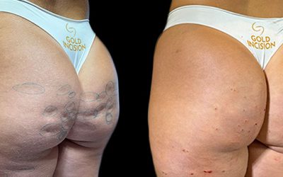 Antes e depois do Protocolo GoldIncision para tratamento da celulite em duas sessões