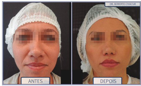 PREENCHIMENTO DAS MAÇÃS DO ROSTO - Dr. Roberto Chacur