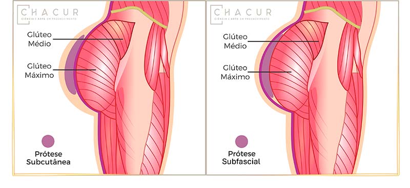 Ilustração implante silicone glúteo
