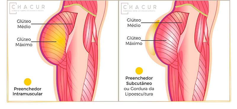 Ilustração plano de preenchimento glúteo