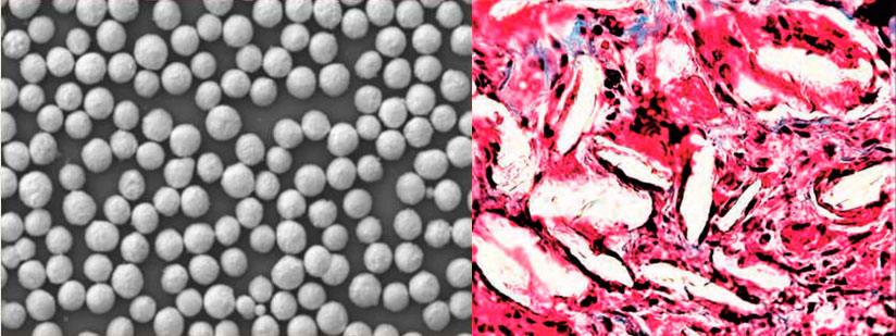 microesferas de preenchedor de longa duração antes de serem injetadas dispersas em carboximetilcelulose e depois dentro do músculo envoltas por fibras de colágeno